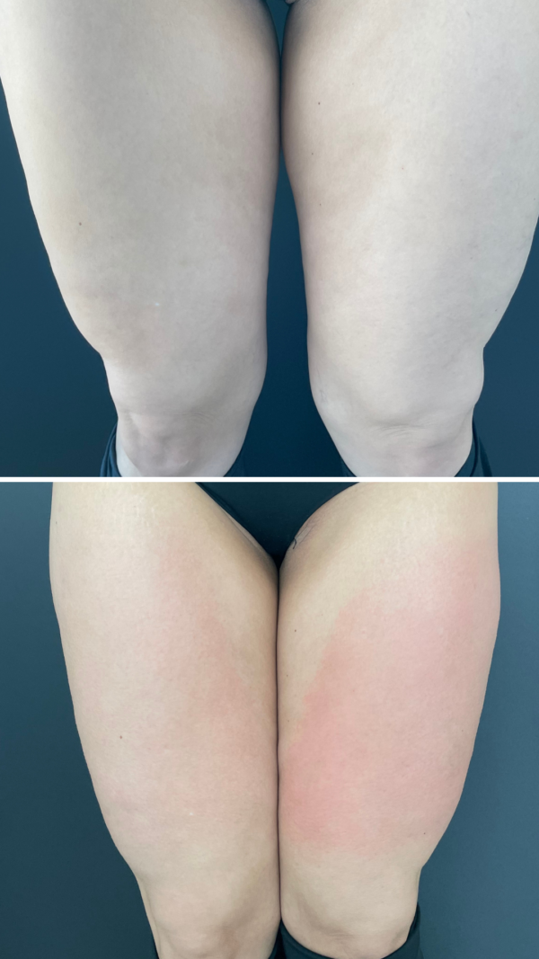 2 Aparatologias BTL + Radiofrecuencia - Imagen 2