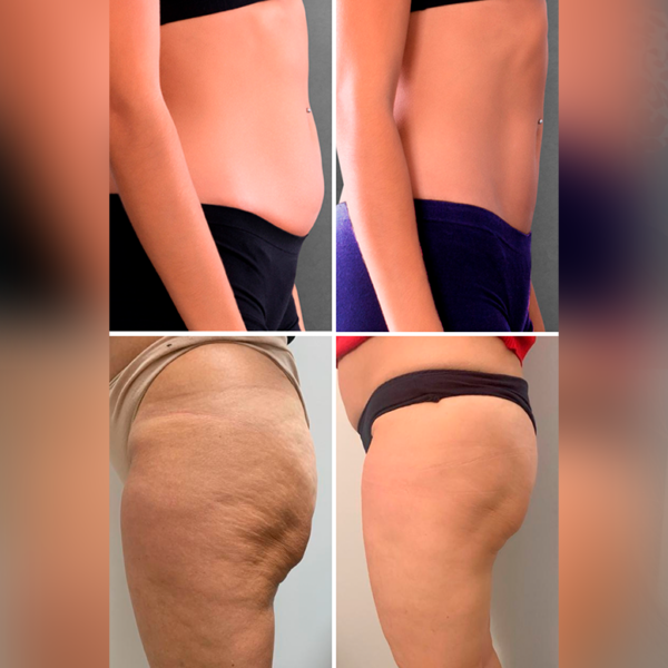 Estimulacion Muscular CMslim