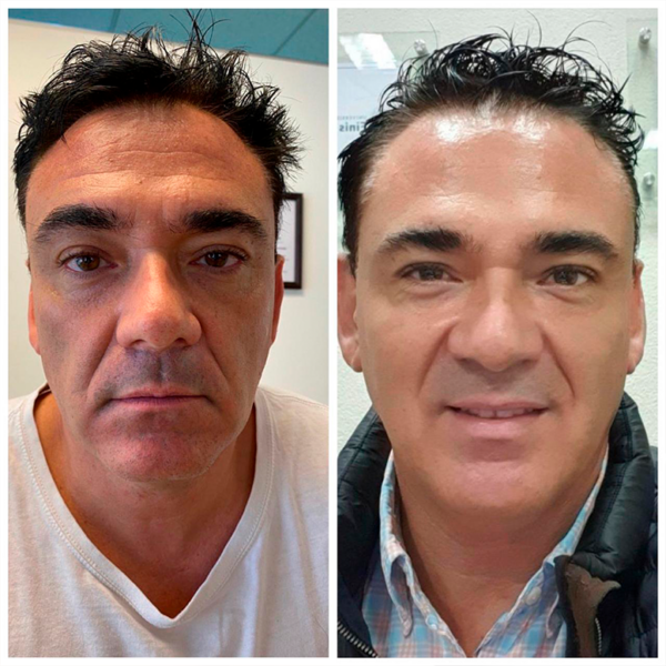 Botox* Open Eyes
