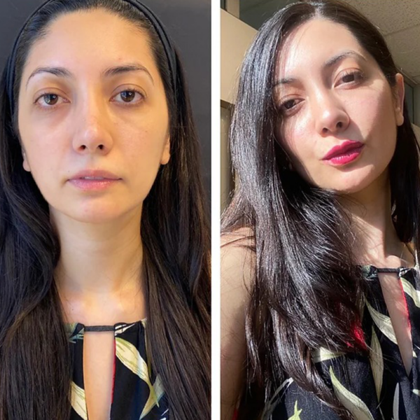 Armonizacion Facial