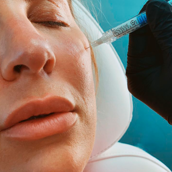 Radiesse - Bioregenerador