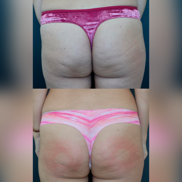 2 Aparatologias BTL + Radiofrecuencia