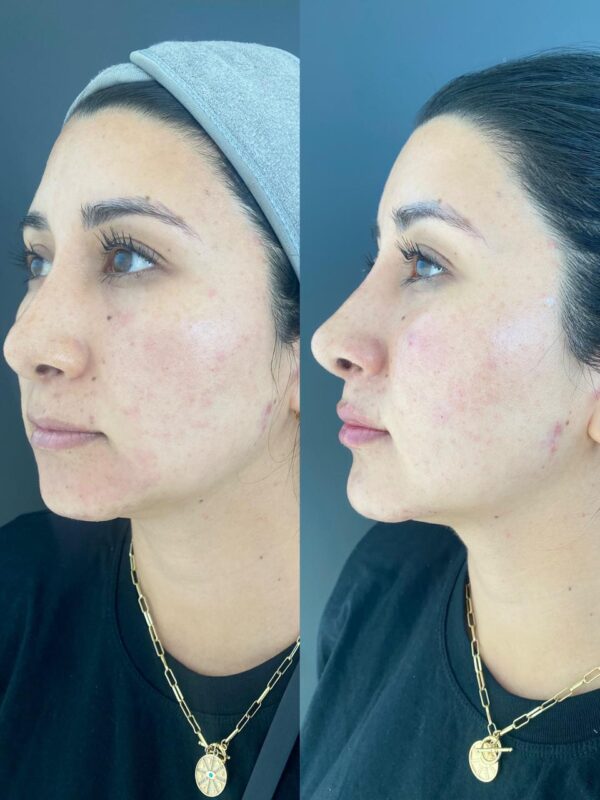 Armonizacion Facial - Imagen 2