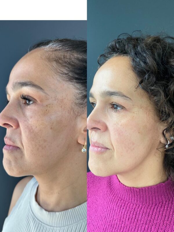 Armonizacion Facial - Imagen 3