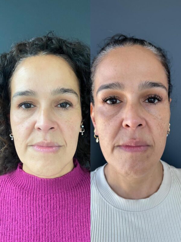 Armonizacion Facial - Imagen 4
